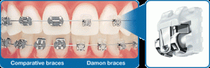 Damon Bracket System