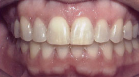 Drobocky Orthodontics - After 1