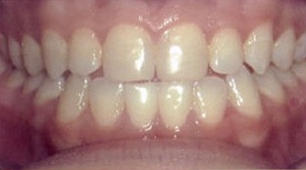 Drobocky Orthodontics - Before 2