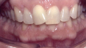 Drobocky Orthodontics - before-1