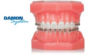 damon-self-ligating-braces