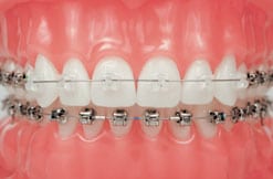 Damon Clear Braces Drobocky Orthodontics