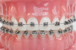 Damon Metal Braces Drobocky Orthodontics