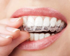 Invisalign for a Holiday gift Bowling Green KY