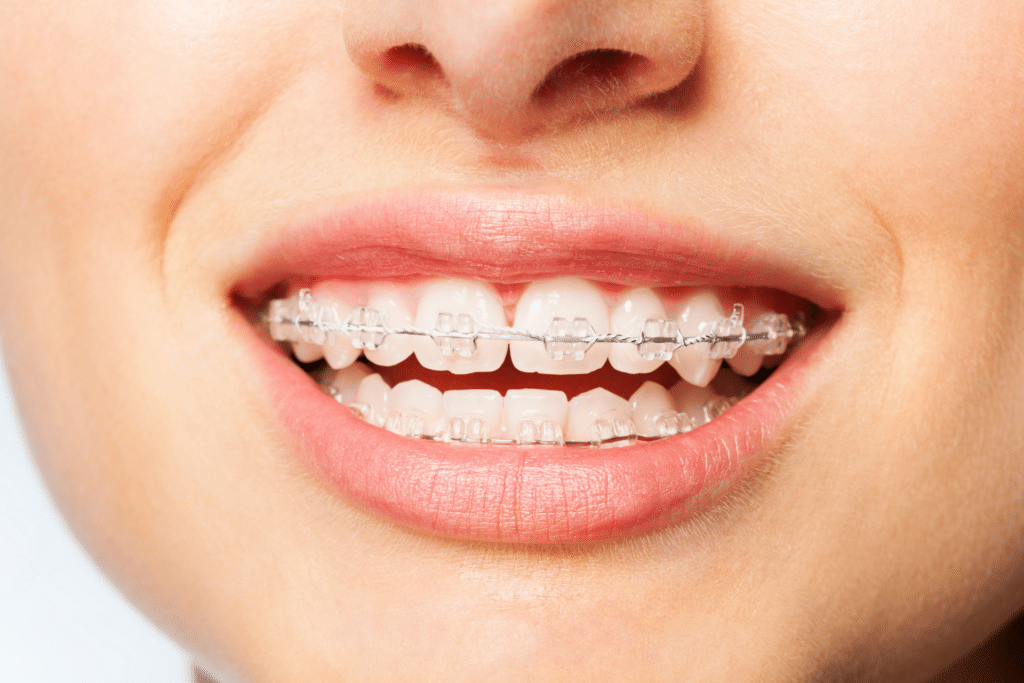 Close-up of a person smiling with clear ceramic braces on their upper and lower teeth
